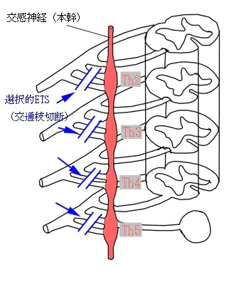 選択的ETS