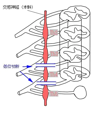 一般的な切除部位