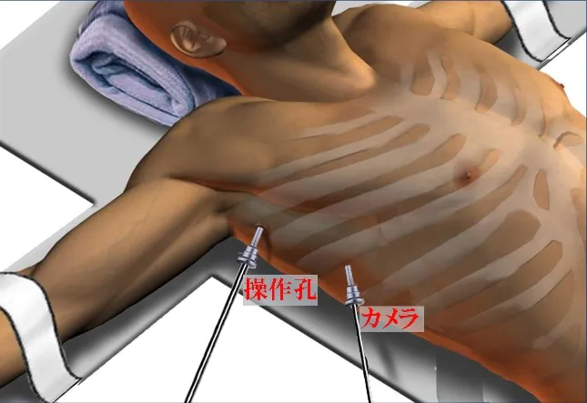 手汗を解消する手術「選択的ETS（胸部交感神経切除術）」