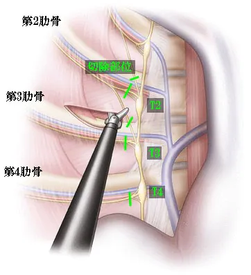 選択的ETS（胸部交感神経切除術）のメリット・特徴
