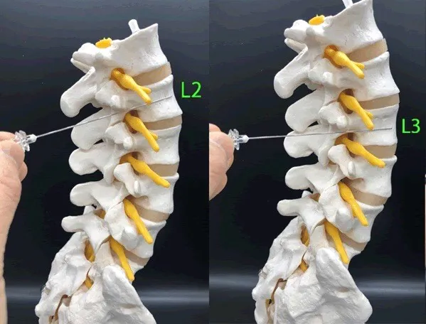 第二腰椎（L2）・第三腰椎（L3）レベルの交感神経節