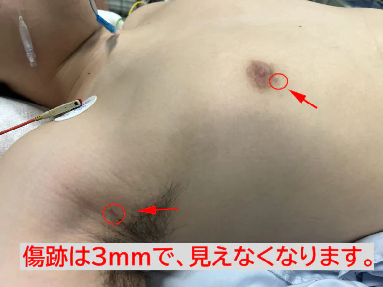 傷は3ｍｍで最小限