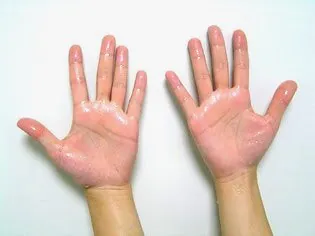 手汗（手掌多汗症）のセルフチェックと検査