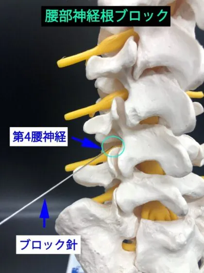 神経根ブロック