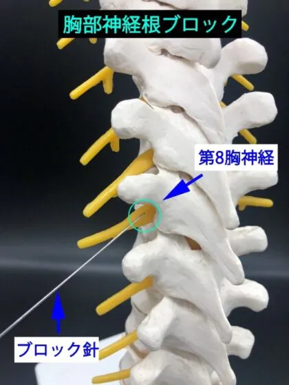 神経根ブロック