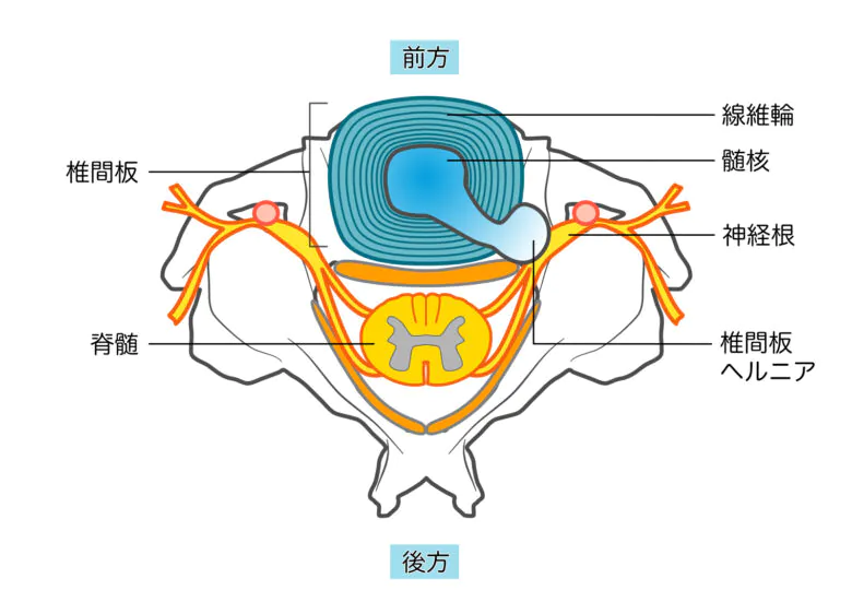 腰椎椎間板ヘルニアの原因