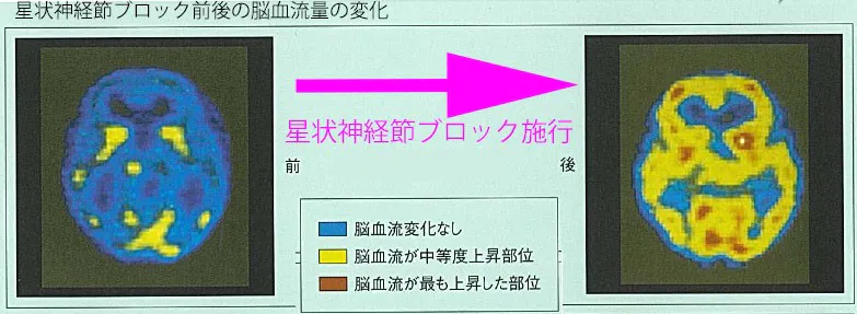 星状神経節ブロック