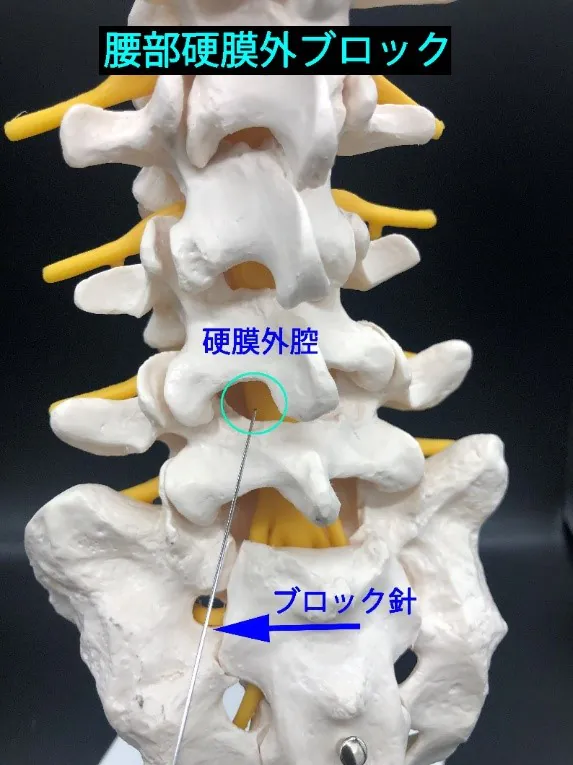 腰部硬膜外ブロック