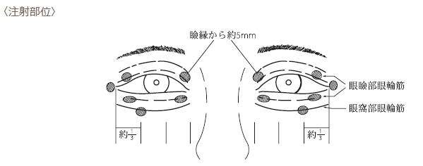 神経ブロック（ボトックス注射）