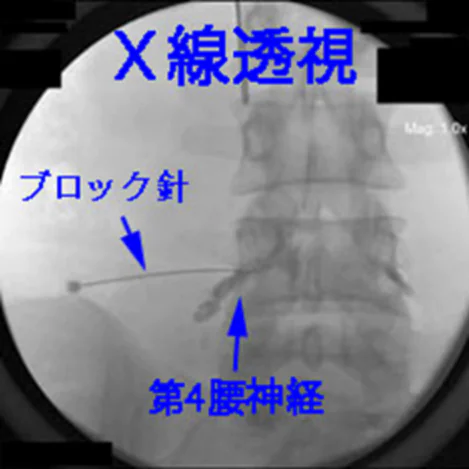 Cアームを用いた透視下神経ブロックについて