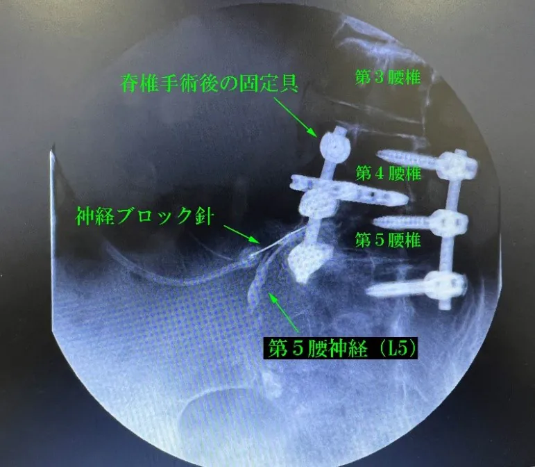 Cアームを用いた透視下神経ブロックについて