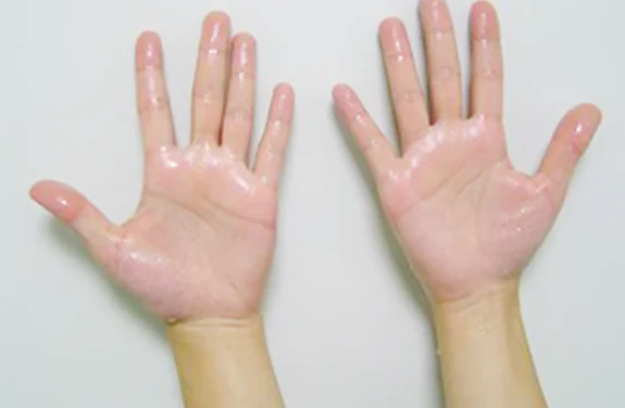 手と脇の多汗症日帰り手術選択的ETSに対応