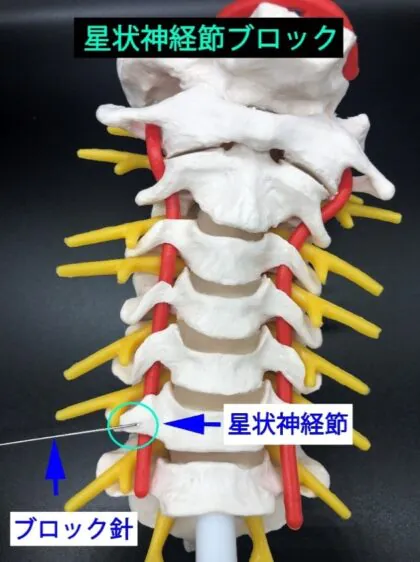 星状神経節ブロック