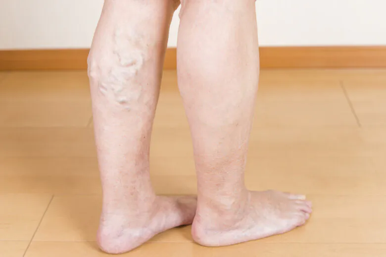足の血管が浮き出るのは下肢静脈瘤？